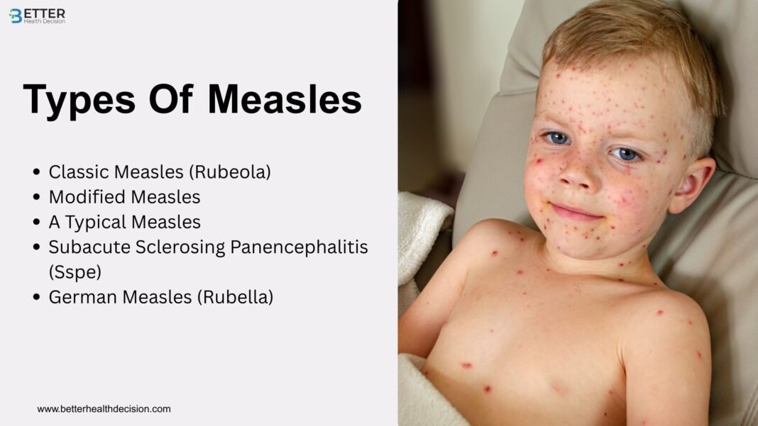 Measles Rash Vs Strep Rash Measles Symptoms, Causes & Treatment: A Complete Guide