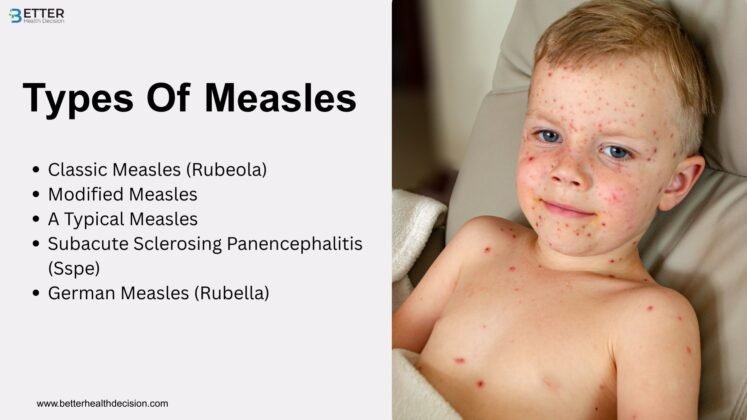 Measles Symptoms, Causes & Treatment: A Complete Guide