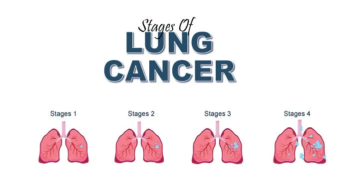 Lung Cancer: Symptoms, Causes, Treatment, Types, and Stages 1 Stages Of Lung Cancer